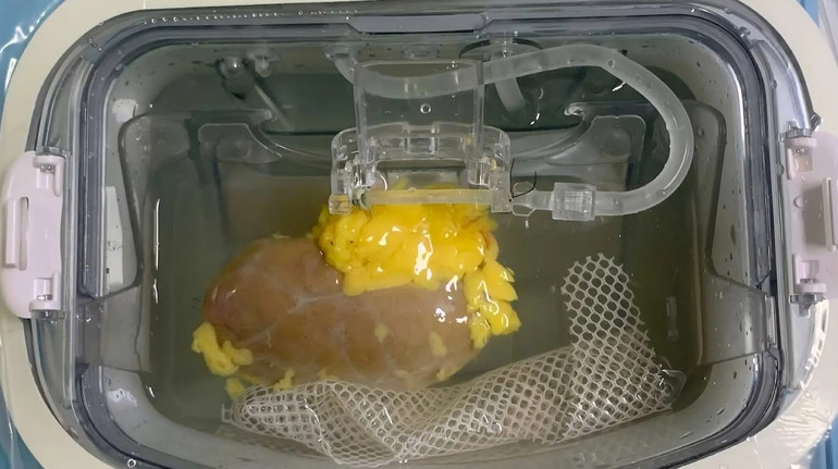 For the first time, scientists managed to change the blood group of a donor organ: how is this possible