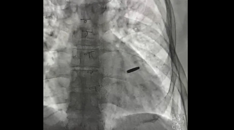 Дива трапляються: у Києві лікарі з серця військового витягли кулю, з якою він жив три роки