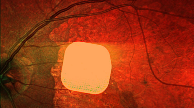 Scientists have created an electronic implant that allows people with incurable vision loss to see again