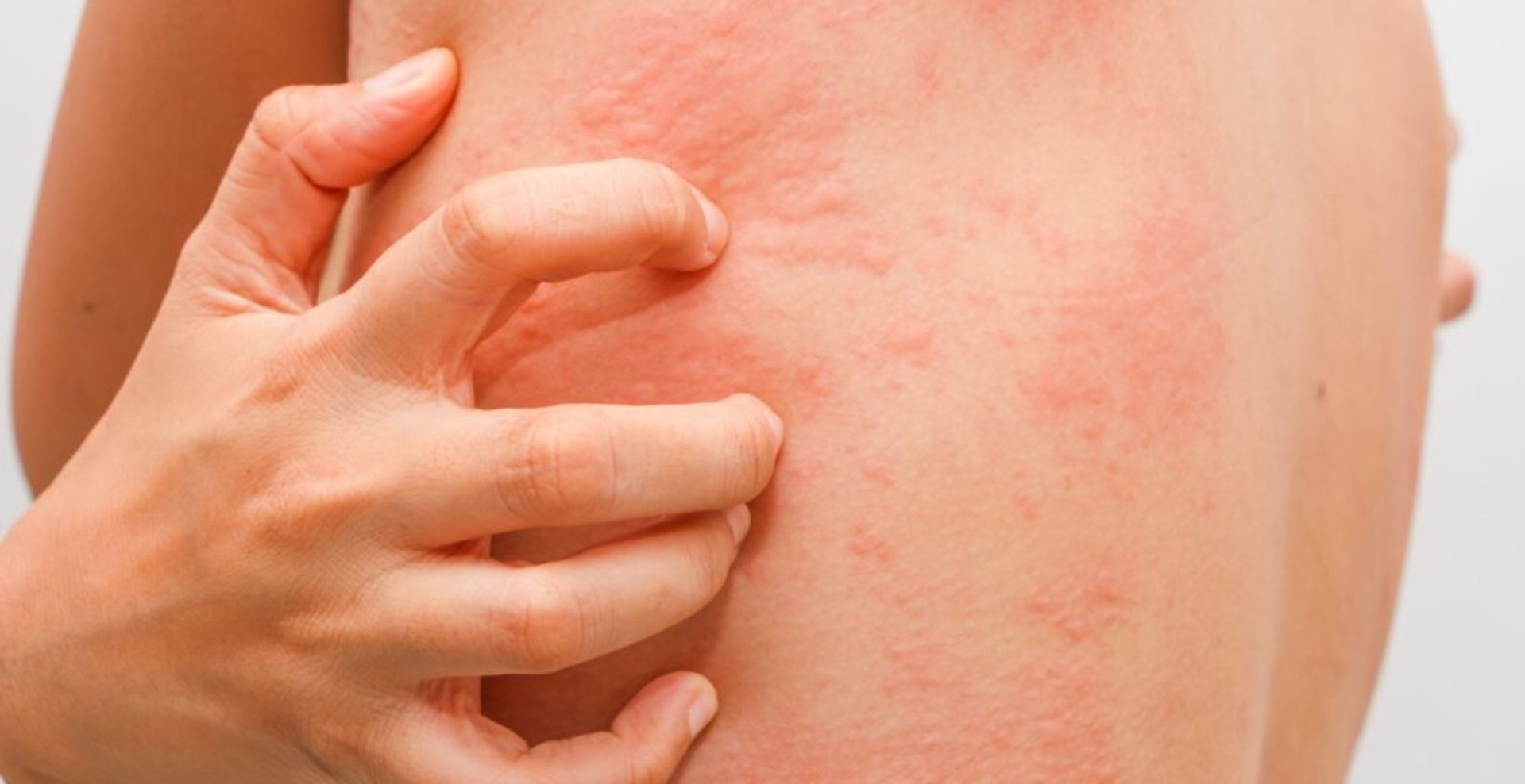 Алергія на холод: з чим її плутають, які є симптоми, лікування та протипоказання? Пояснює алерголог
