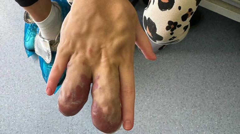 У Львові медики допомогли дитині з рідкісною аномалією: її пальці були збільшені у 4 рази