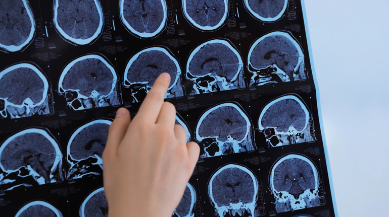 Допоміг ШІ: вчені з Великої Британії виявили два нові підтипи розсіяного склерозу