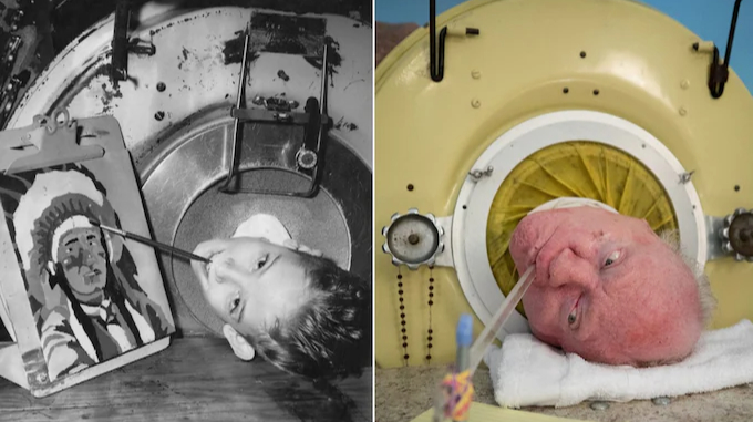 A man who spent 70 years in a metal “iron lung” device has died