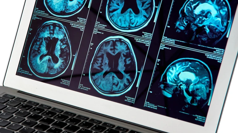 Бактерія, яка роками живе в оці, може бути пов’язана з хворобою Альцгеймера – вчені