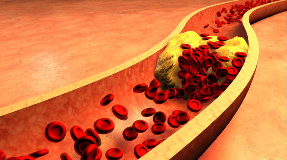 Scientists have found microplastics in the blood vessels of people with atherosclerosis