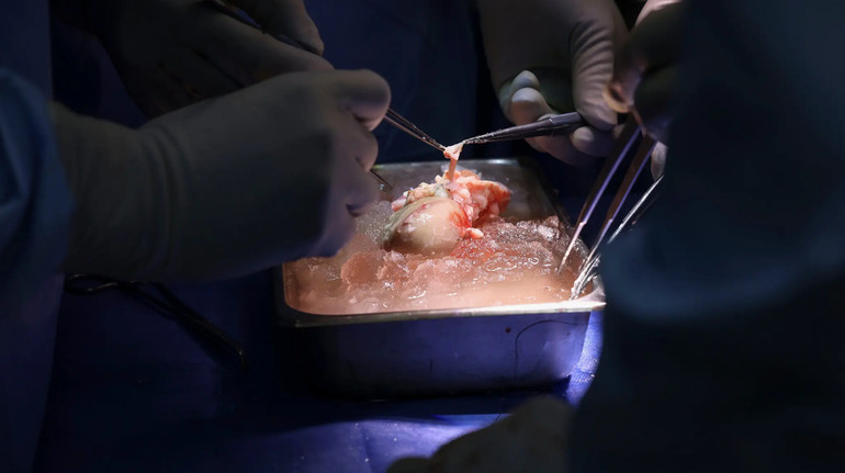 У США з лікарні виписали чоловіка, якому вперше успішно пересадили нирку свині