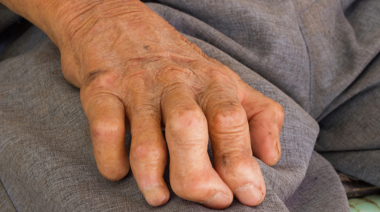 Вперше за понад 40 років в Європі у двох масажисток виявили проказу: які симптоми хвороби та чи існують ліки