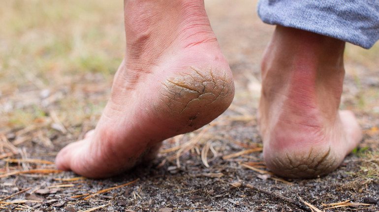 Тріщини на п’ятах: чому виникають та як їх позбутися