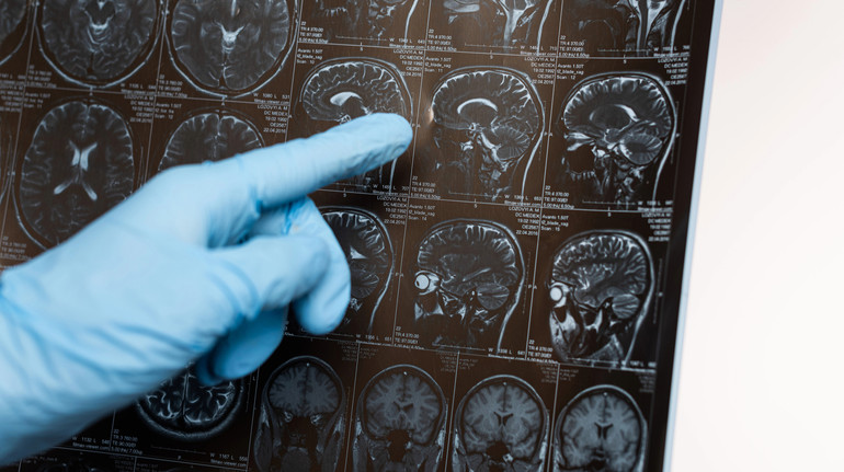 Younger generations are less likely to suffer from dementia – research