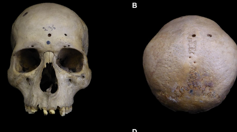 У Стародавньому Єгипті лікували рак? Вчені знайшли сліди незвичних порізів на 4000-річному черепі