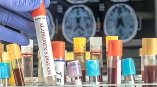 Аналіз крові може передбачити ризик деменції у жінок за десятки років до появи симптомів – учені