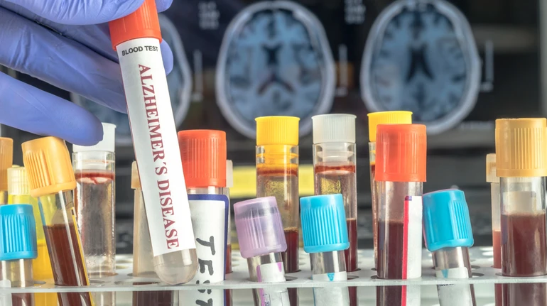 Аналіз крові може передбачити ризик деменції у жінок за десятки років до появи симптомів – учені