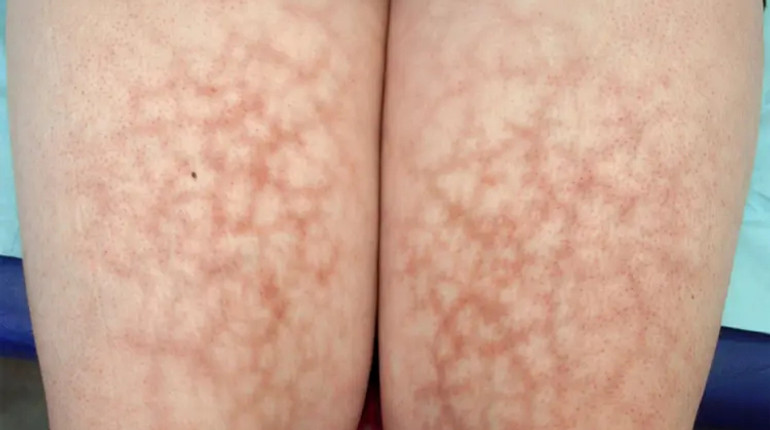 Синдром підсмаженої шкіри: лікарка назвала ще одну загрозу від грілок та обігрівачів