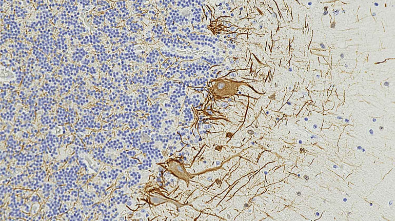 Аналіз крові зможе передбачати розсіяний склероз за 7 років до появи перших його симптомів – вчені