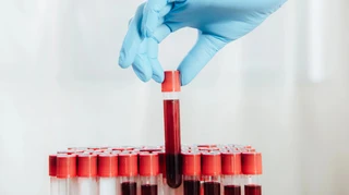 Аналіз крові на 50 видів раку не довів ефективності – масштабне дослідження