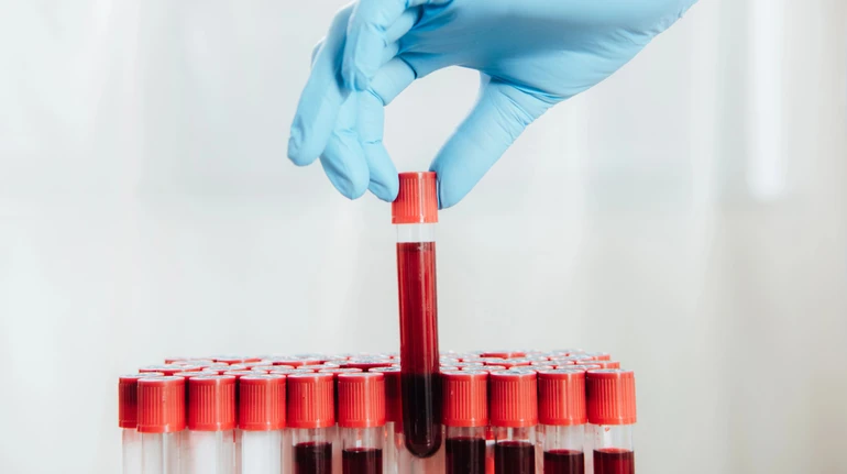 Аналіз крові на 50 видів раку не довів ефективності – масштабне дослідження