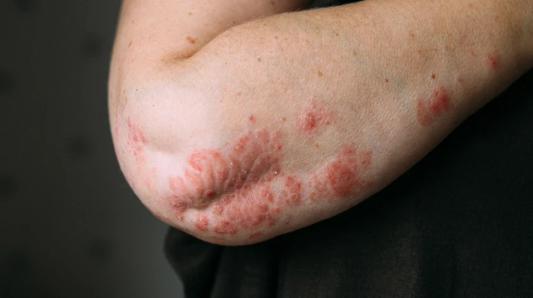 10 міфів про псоріаз: чи можна ним заразитися та повністю вилікувати?