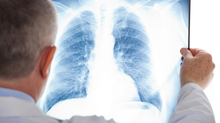 Препарат AstraZeneca провалився на пізньому етапі дослідження щодо деяких видів раку легенів