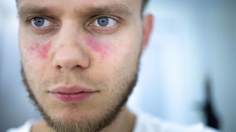Why is lupus erythematosized and what are the symptoms