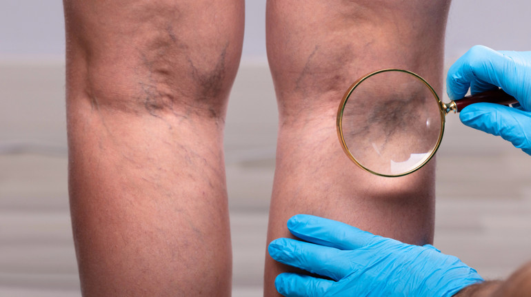 8 тривожних ознак, які можуть свідчити про тромб