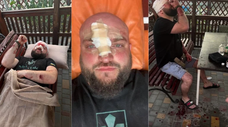 На Одещині ветерана побили арматурою через зауваження щодо російської музики