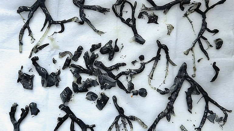 Китайські лікарі дістали з дихальних шляхів літнього чоловіка зліпки його бронхів із сажі