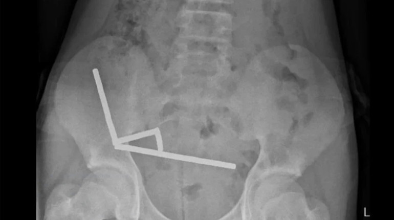 In New Zealand, a teenager swallowed almost a hundred magnets: how doctors saved the child from necrosis