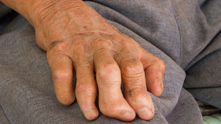 Вперше за понад 40 років в Європі у двох масажисток виявили проказу: які симптоми хвороби та чи існують ліки