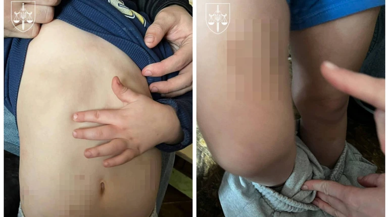 На Київщині засудили чоловіка, який бив дітей своєї співмешканки до гематом