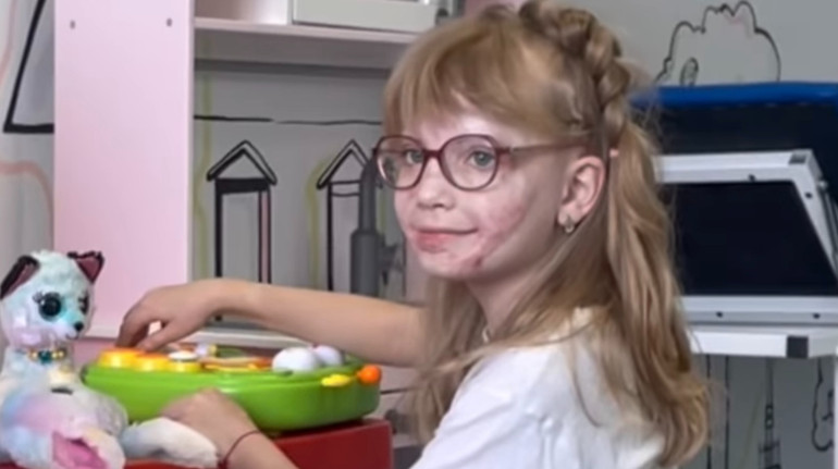 Виконали десятки операцій: 7-річна Аня, що постраждала під час авіатрощі у Броварах, досі долає наслідки опіків