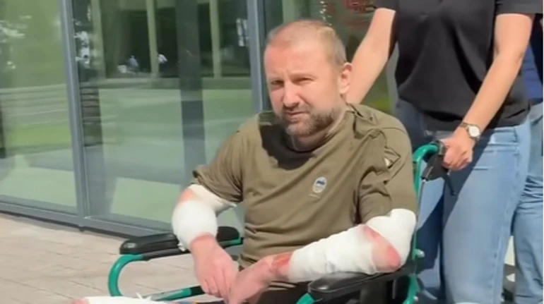 Рани закривали шкірою свині та риби: у Львові врятували чоловіка з опіками 80% тіла через вибух бойлера
