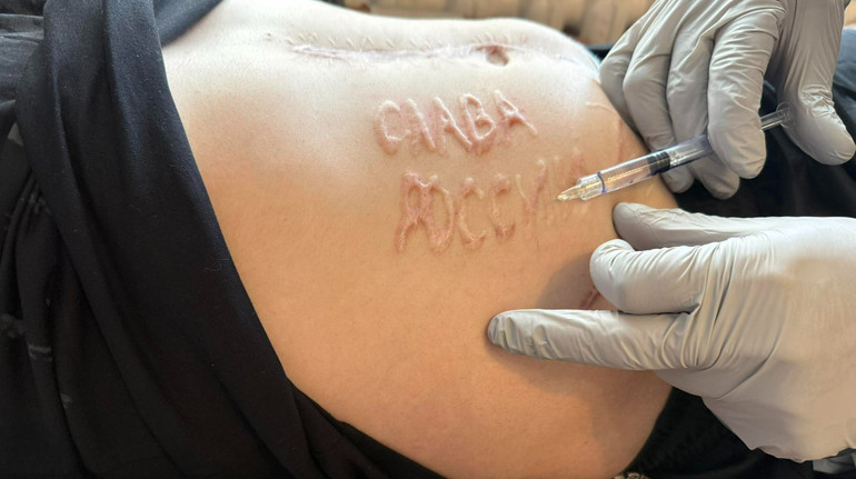 The procedure will be painful: the doctor told how the glory of Russia will be removed from the body of the military