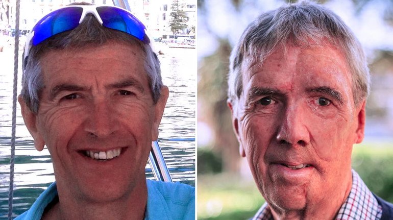 Британцю з опіками шкіри відновили частину обличчя за допомогою 3D-принтера