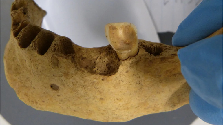 Що вплинуло на поширеність карієсу у наш час? Підказки можуть міститися у зубі бронзового віку
