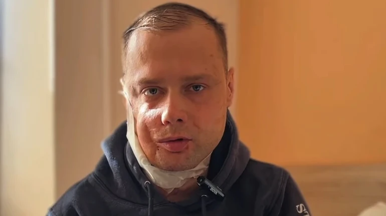 18-та операція: у Львові реконструювали обличчя ветерану, який з дитинства не міг жувати