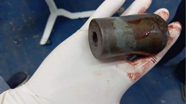 Лікарі польового госпіталю дістали з ноги захисника невідомий зразок касетного боєприпасу