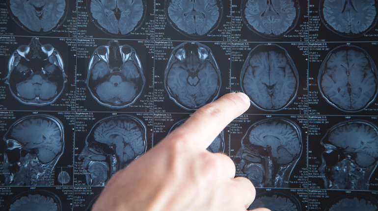 Може проникати всередину? Вчені назвали 5 шляхів, як мікропластик може нашкодити мозку