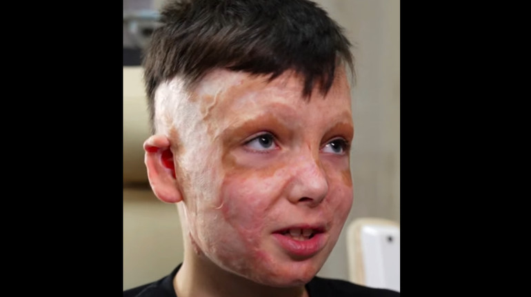 36 операція за 3 роки: історія 10-річного хлопчика, який вижив після ракетного удару РФ в 2022 році