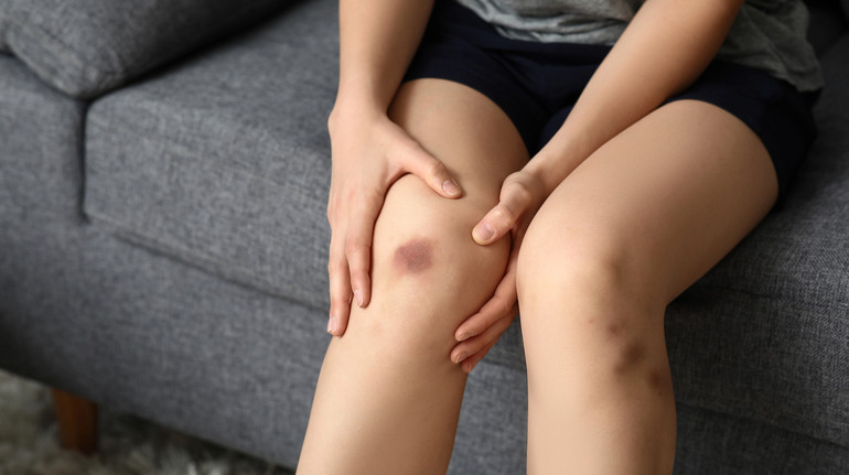 Червоні, фіолетові, сині чи навіть жовті: як виникають синці та чому в них різне забарвлення