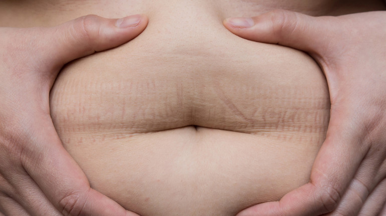 Why is fat on the abdomen increasing with age and how to fight it