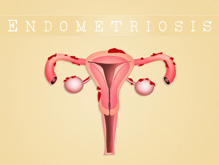 ендометріоз