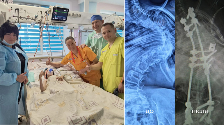 У Львові медики на 85% випрямили хребет 12-річної пацієнтки зі сколіозом 4-го ступеня