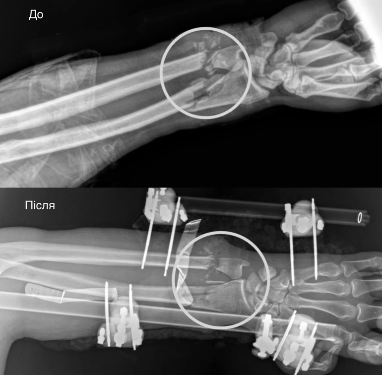 Попереду в чоловіка тривала реабілітація і ще одна операція