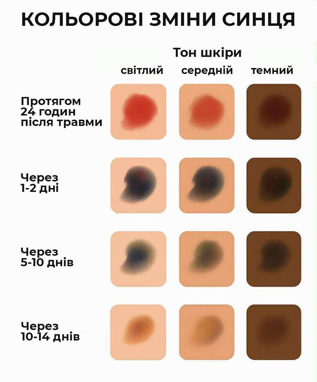 стадії зміни кольору синця