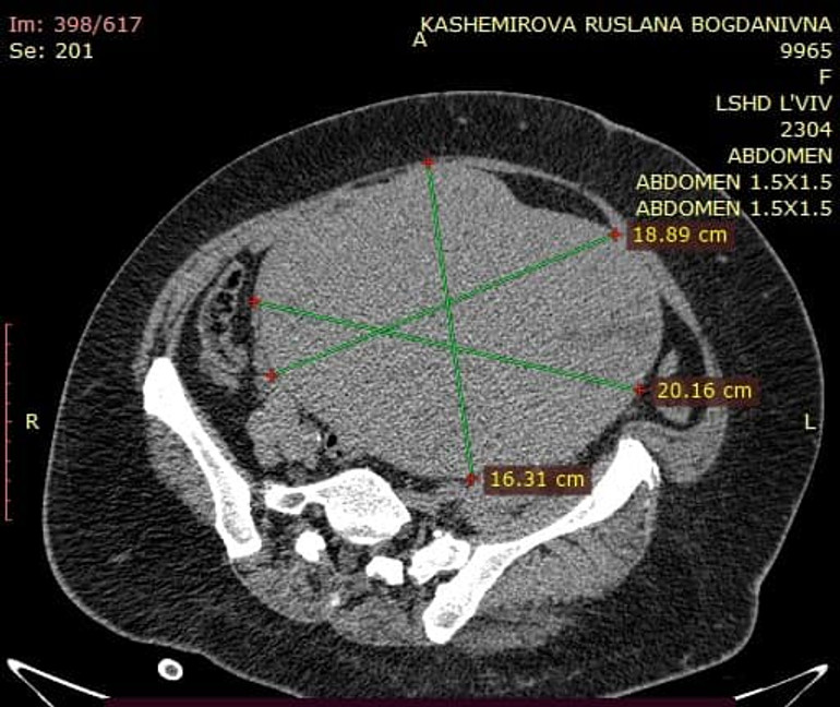 Тягнути вже не було куди. Потрібно – негайно оперувати!