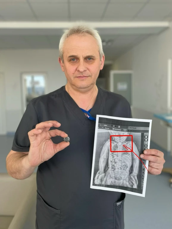 Рентгенівський знімок допоміг нарешті з’ясувати – у стравоході дитини був сторонній предмет