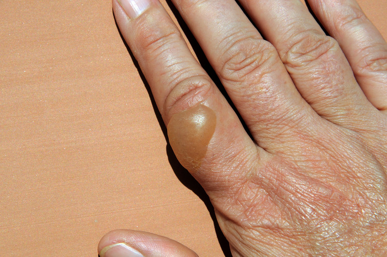 пухирі при опіках