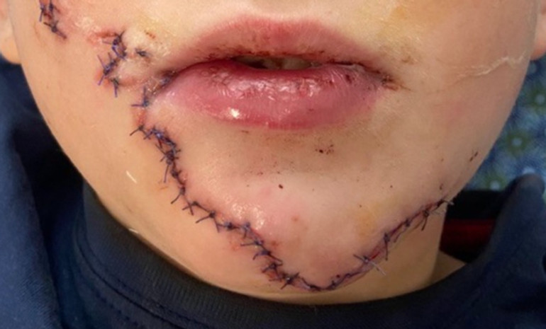 10-річний Тарас після операції