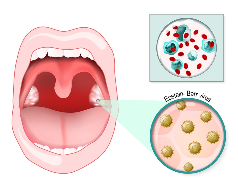 інфекційний мононуклеоз