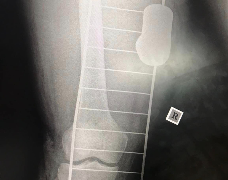 X-ray image of the injured leg